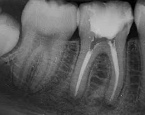 Tratamientos de Endodoncia Dentistas Getafe