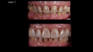 estética dental composite-clínica dental Getafe