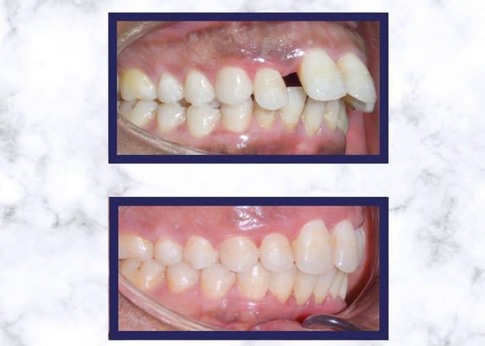 Ortodoncia Brackets Getafe clinica dental 5