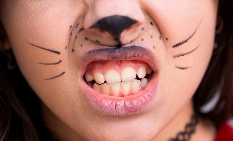 Dentistas en Getafe (Madrid) Dental Studio Getafe sangrado de encias